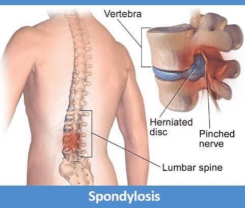 Spondylolisthesis treatment in Lagos