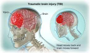 mild Traumatic Brain Injury(mTBI)