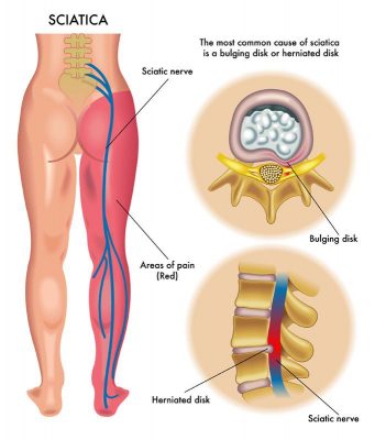 Physiotherapy Treatment for Sciatica in Lekki Lagos