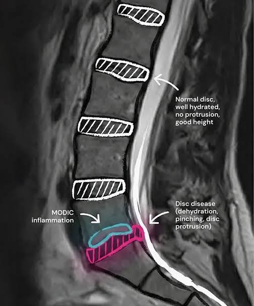 Treatment for sciatica pain in Lekki Lagos
