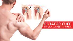 Rotator Cuff Injury Treatment in Lekki Lagos