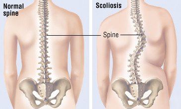 scoliosis treatment in lekki lagos