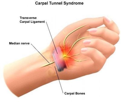 Carpal Tunnel Syndrome (CTS) Treatment in Lekki Lagos