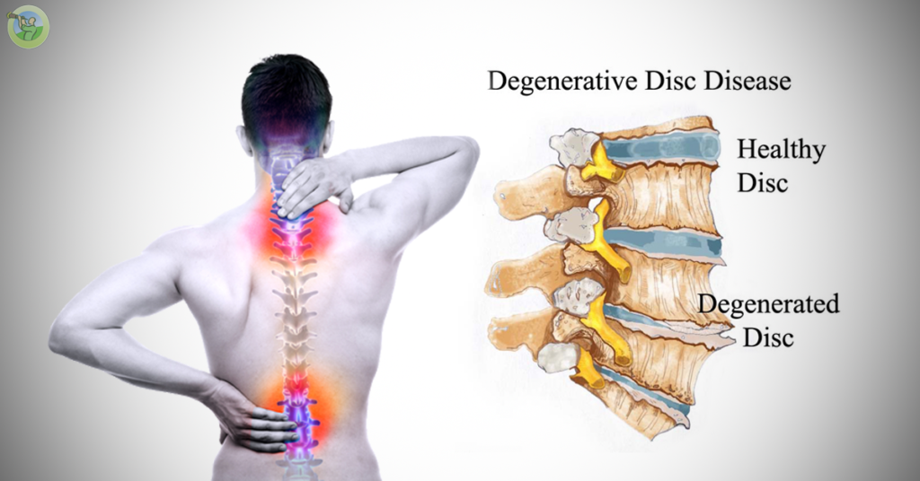 Degenerative Disc Disease Treatment