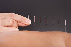 acupuncture treatment in Lekki lagos