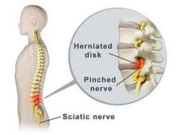 pinched nerve treatment