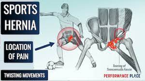 sports hernia treatment