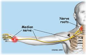 Radiating pain from the neck to hand