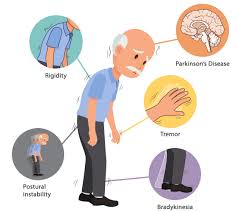 Physiotherapy for Parkinson’s Disease in Lekki Lagos