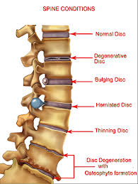 Do I Have a Slipped Disc?
