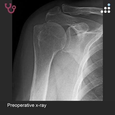 Rotator Cuff Tear Treatment in Lagos