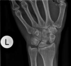 Wrist Fracture Treatment in Lagos