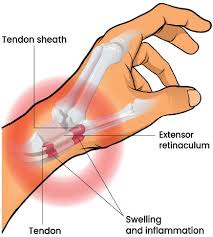 De Quervain's Tenosynovitis Treatment in Lagos
