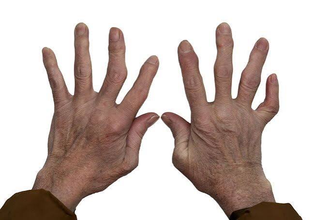 Book Arthritis Treatment in Lagos
