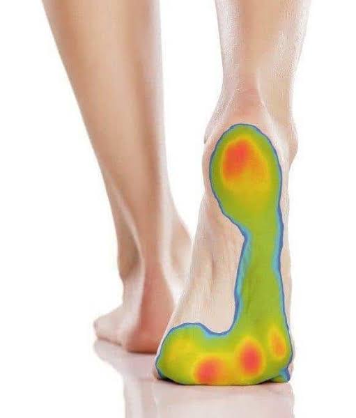 Foot Pain, Plantar Fasciitis & Flat Feet: When You Need Orthotics vs Physiotherapy