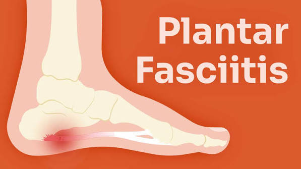 Foot Pain, Plantar Fasciitis & Flat Feet: When You Need Orthotics vs Physiotherapy
